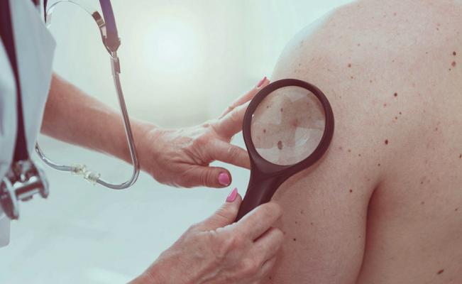 ¿El cáncer de piel aumenta con la edad?