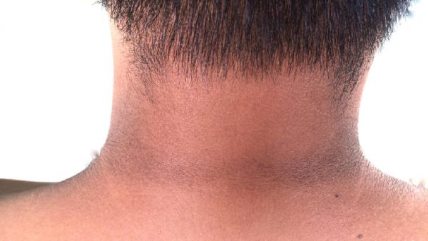 Cinco síntomas que revelan la existencia de prediabetes